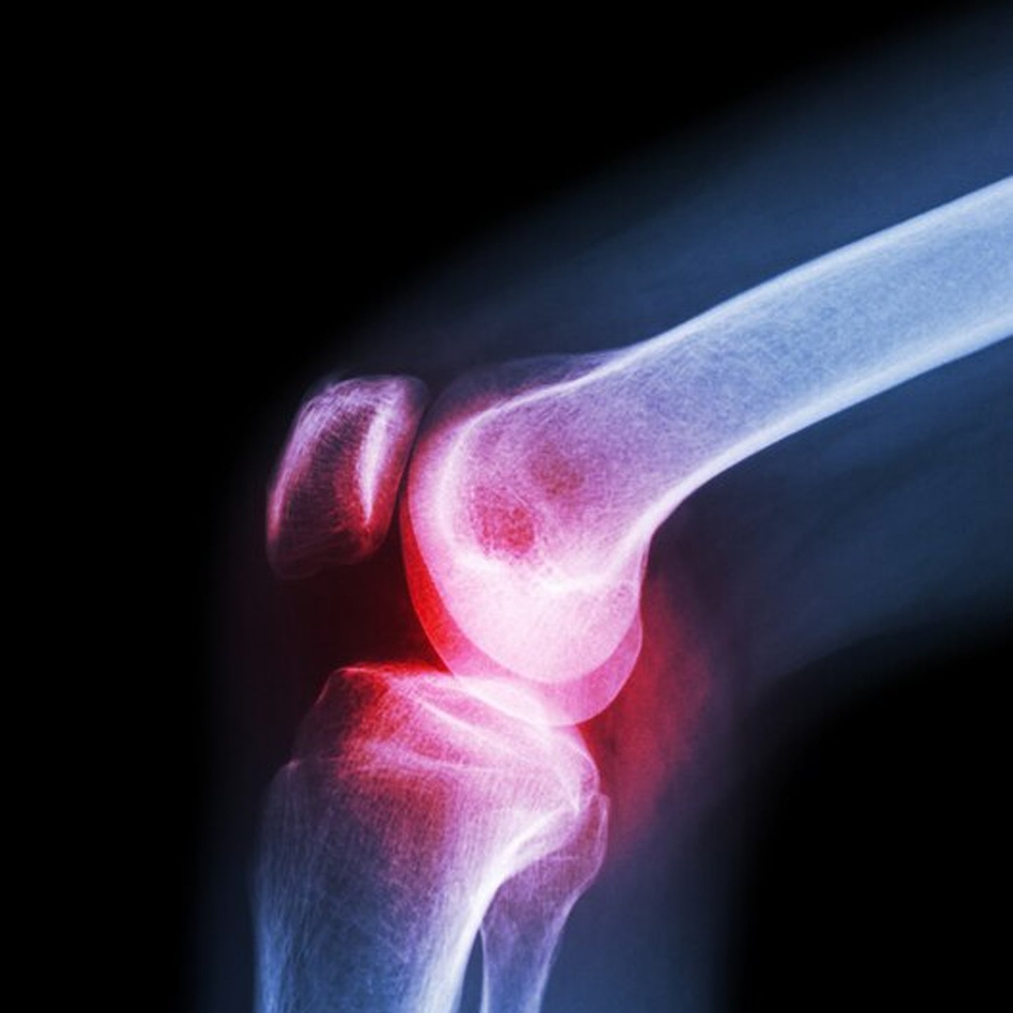 Knee Cap For Knee Support (Size XL)