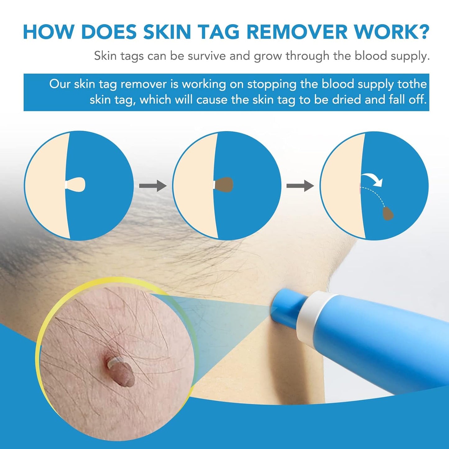 Skintag Remover Kit 2 In 1 For Micro To Large (2 Mm - 8 Mm 1 Set)