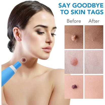 Skintag Remover Kit 2 In 1 For Micro To Large (2 Mm - 8 Mm  1 Set)